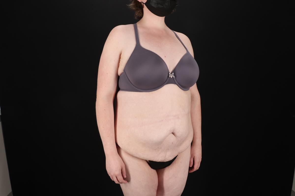 Fleur De Lis Tummy Tuck Before & After Patient #9506