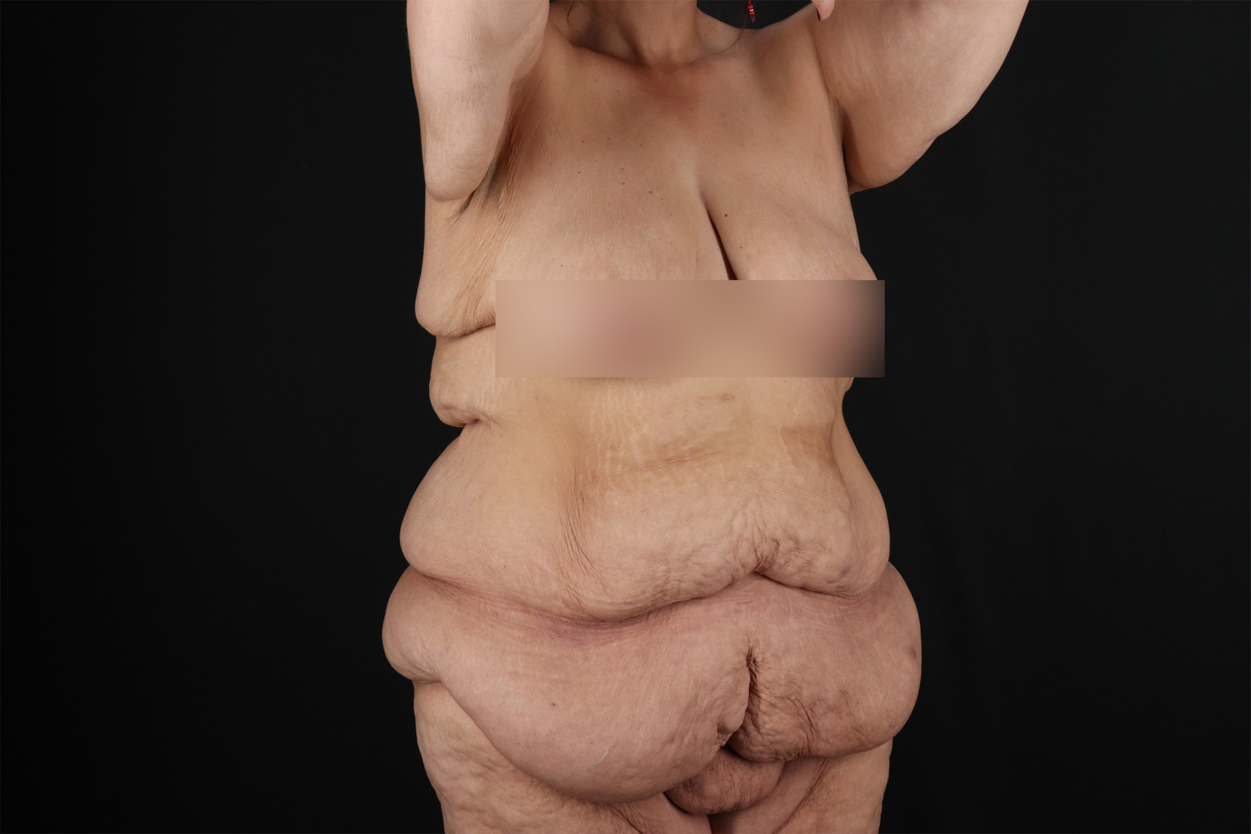 Fleur De Lis Tummy Tuck Before & After Patient #9509