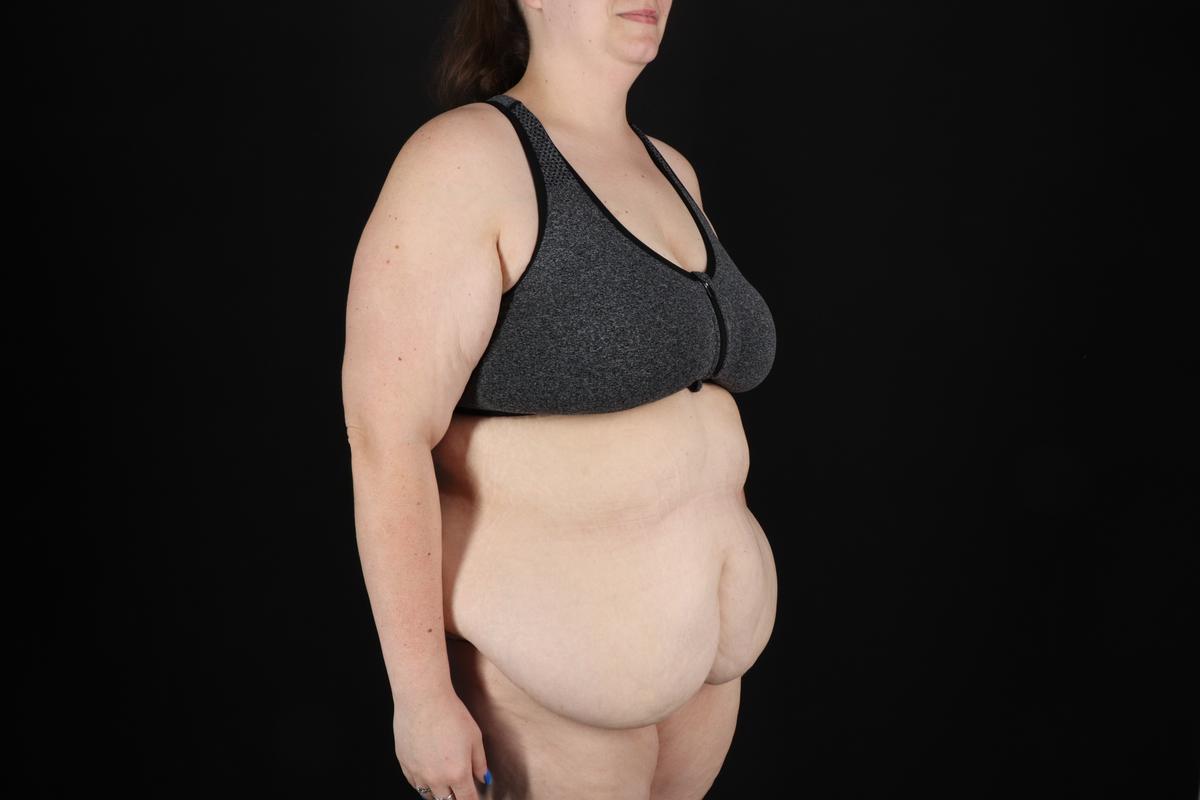 Fleur De Lis Circumferential Body Lift Before & After Patient #9284