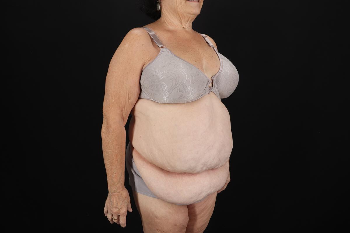 Fleur De Lis Tummy Tuck Before & After Patient #9507