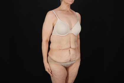 Fleur De Lis Circumferential Body Lift Before & After Patient #9328