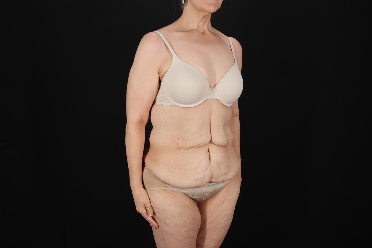 Fleur De Lis Circumferential Body Lift Before & After Patient #9328