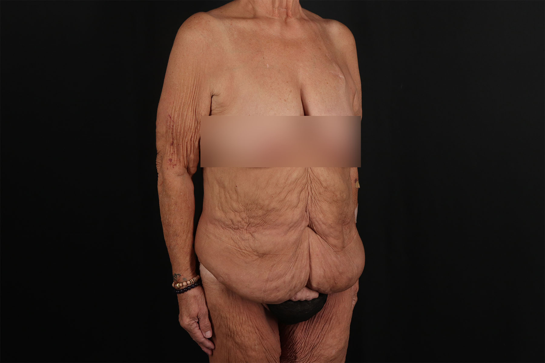 Fleur De Lis Circumferential Body Lift Before & After Patient #9281