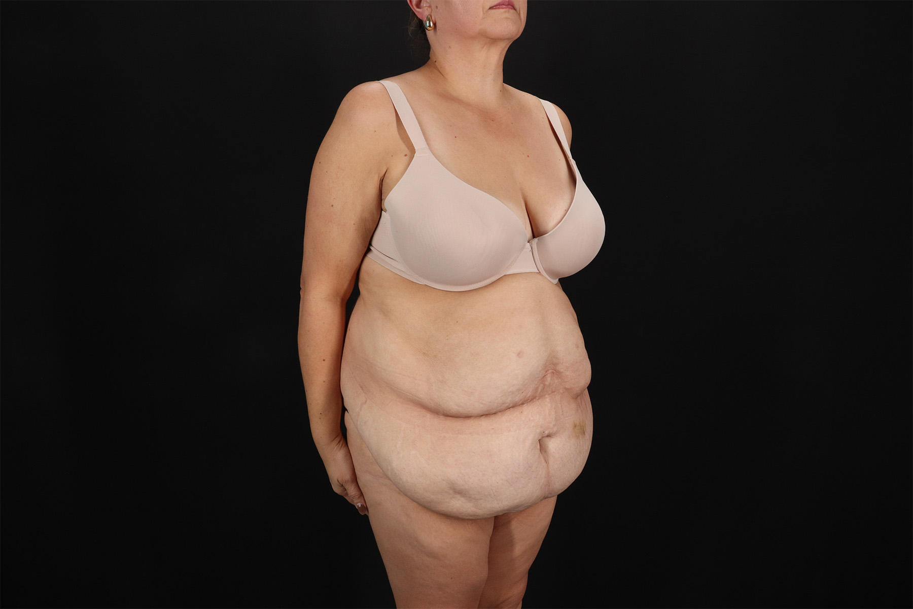 Fleur De Lis Tummy Tuck Before & After Patient #9510