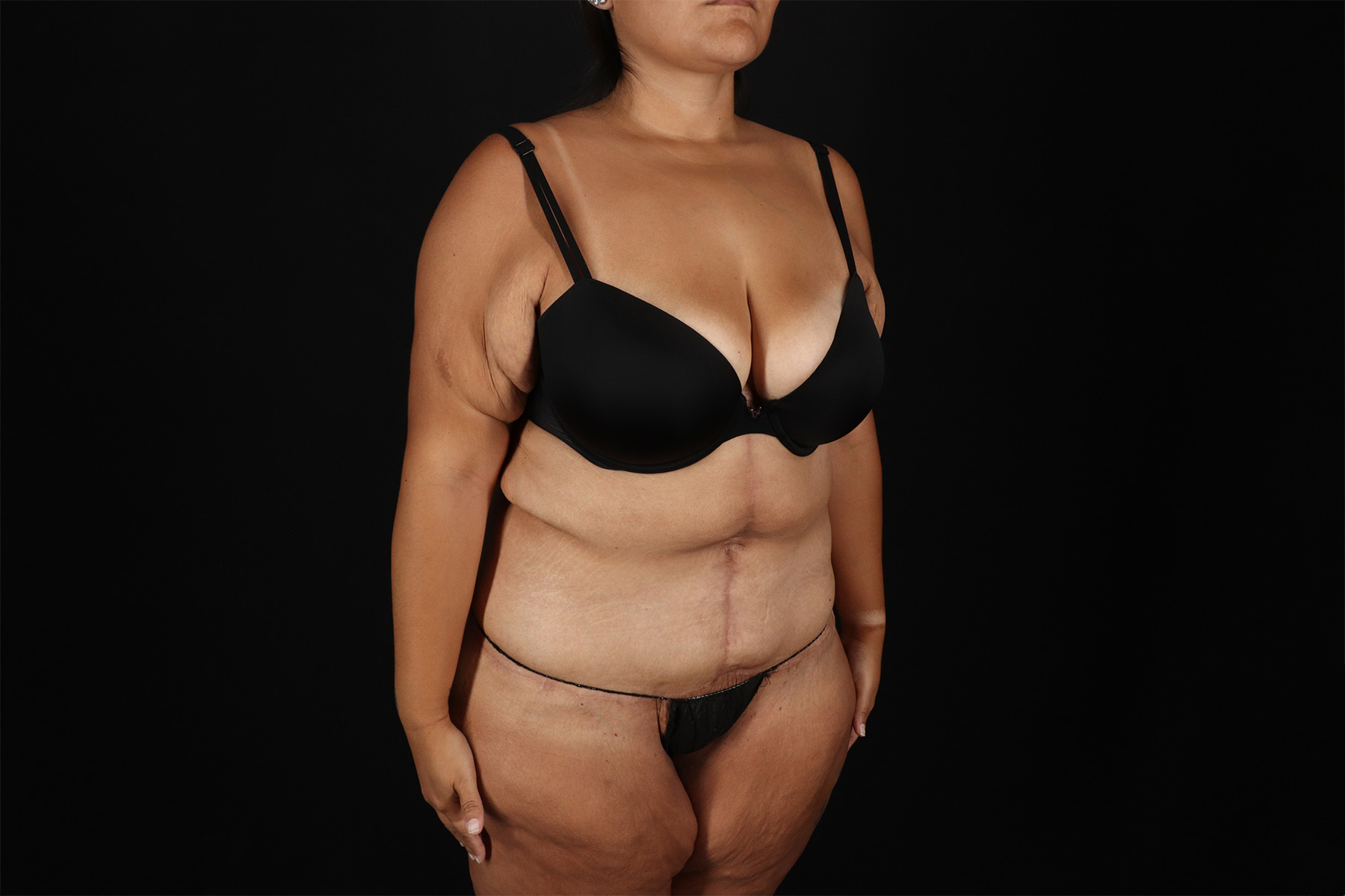 Fleur De Lis Tummy Tuck Before & After Patient #9508