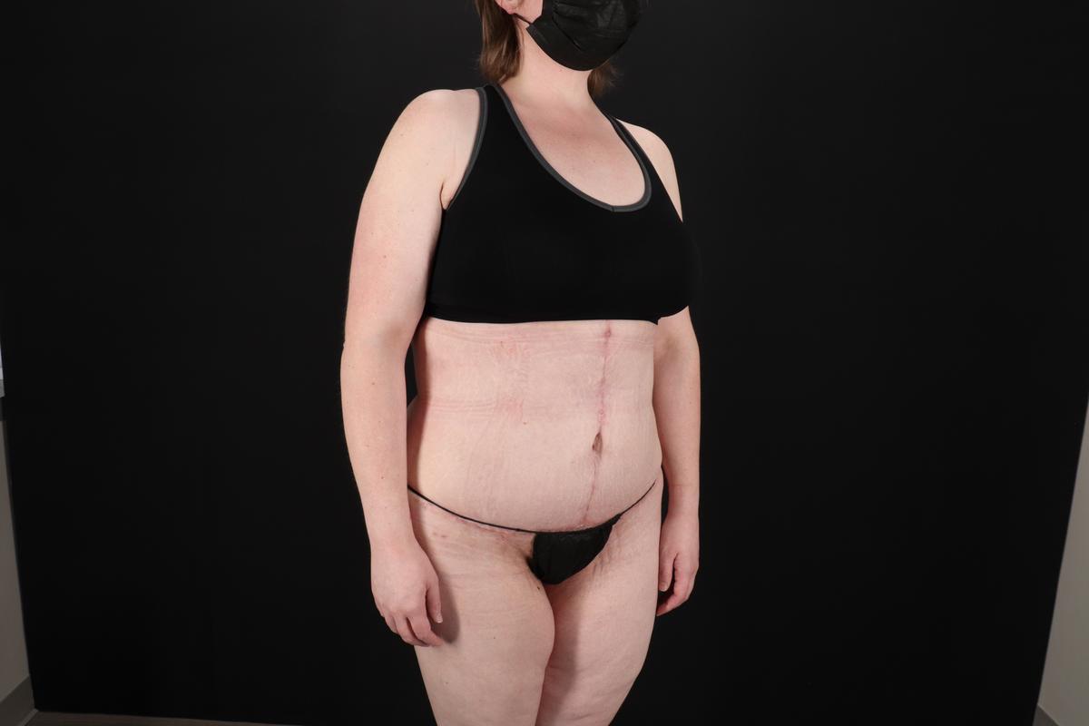 Fleur De Lis Tummy Tuck Before & After Patient #9506