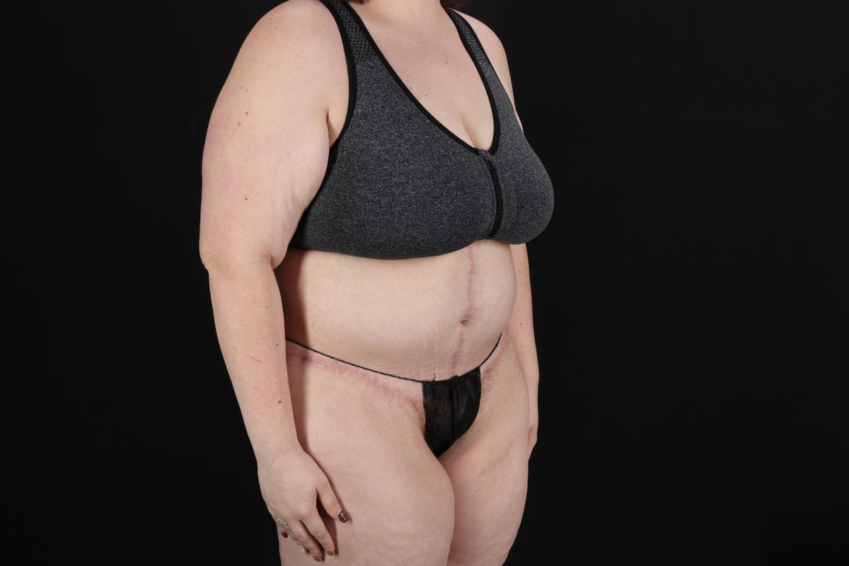 Fleur De Lis Circumferential Body Lift Before & After Patient #9284