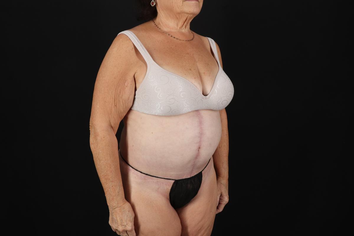 Fleur De Lis Tummy Tuck Before & After Patient #9507