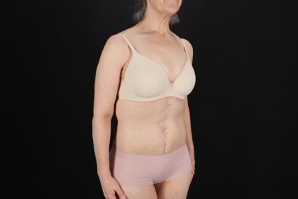 Fleur De Lis Circumferential Body Lift Before & After Patient #9328