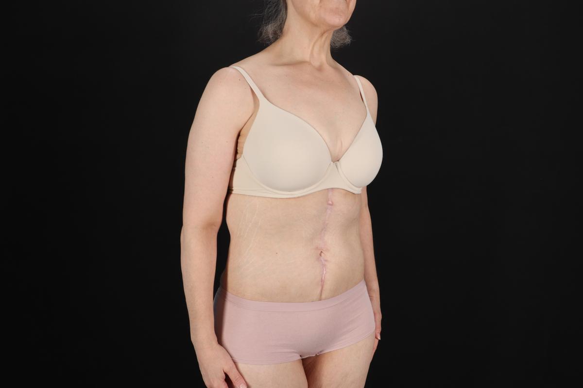 Fleur De Lis Circumferential Body Lift Before & After Patient #9328