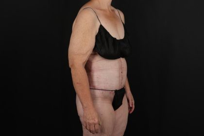 Fleur De Lis Circumferential Body Lift Before & After Patient #9285