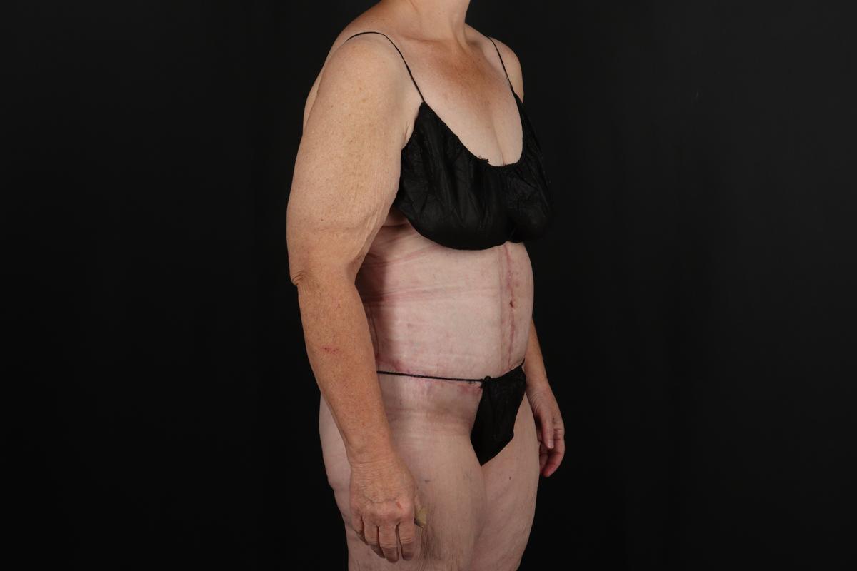 Fleur De Lis Circumferential Body Lift Before & After Patient #9285