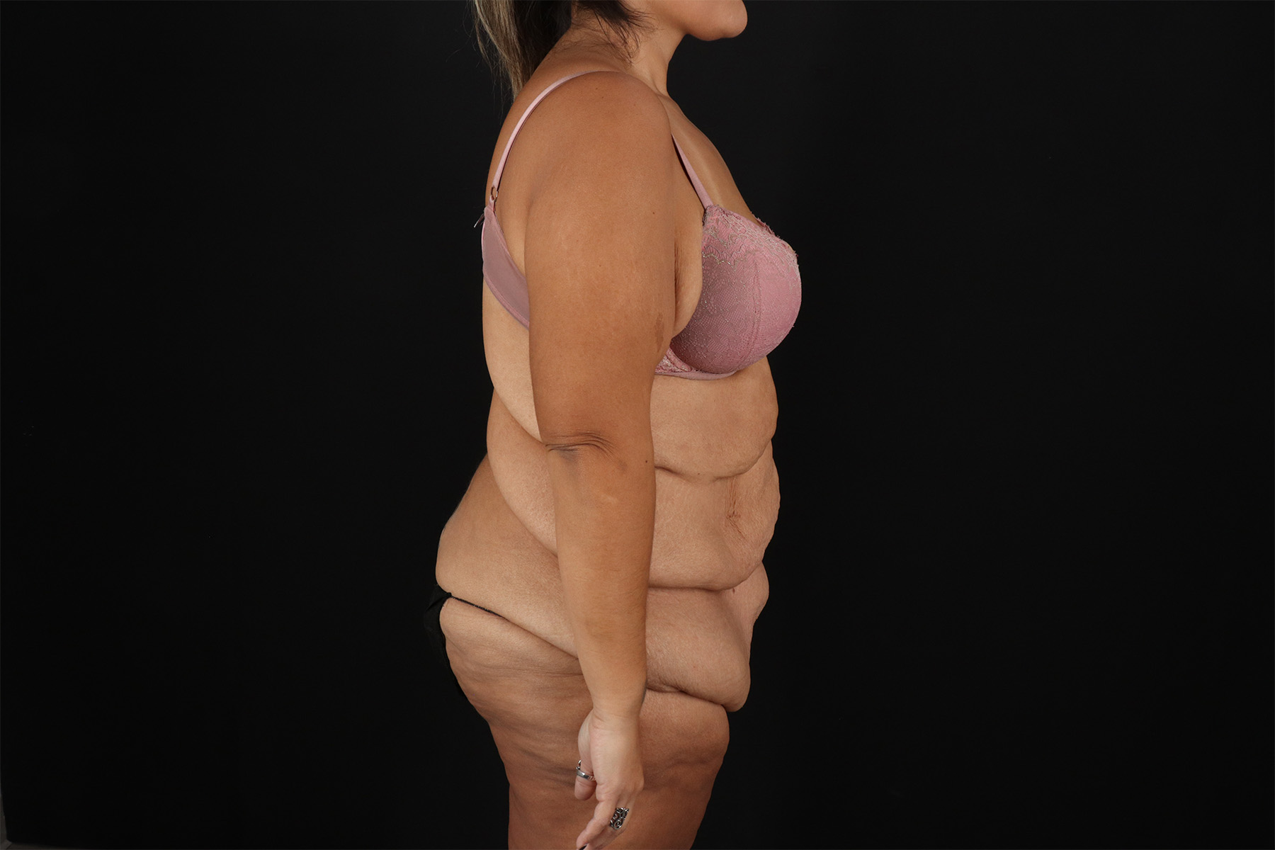 Fleur De Lis Tummy Tuck Before & After Patient #9508