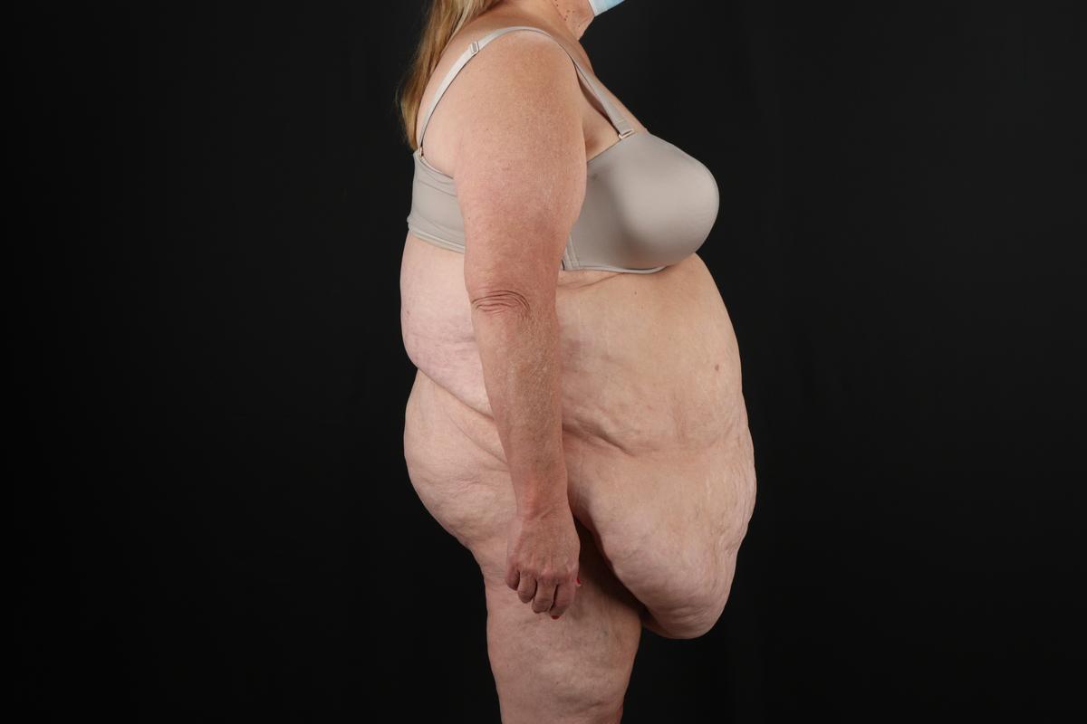 Fleur De Lis Circumferential Body Lift Before & After Patient #9286