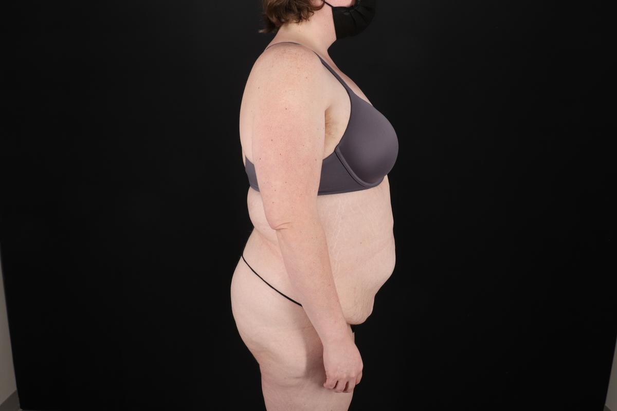 Fleur De Lis Tummy Tuck Before & After Patient #9506