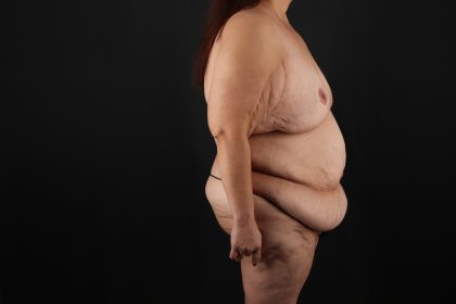 Fleur De Lis Circumferential Body Lift Before & After Patient #9278