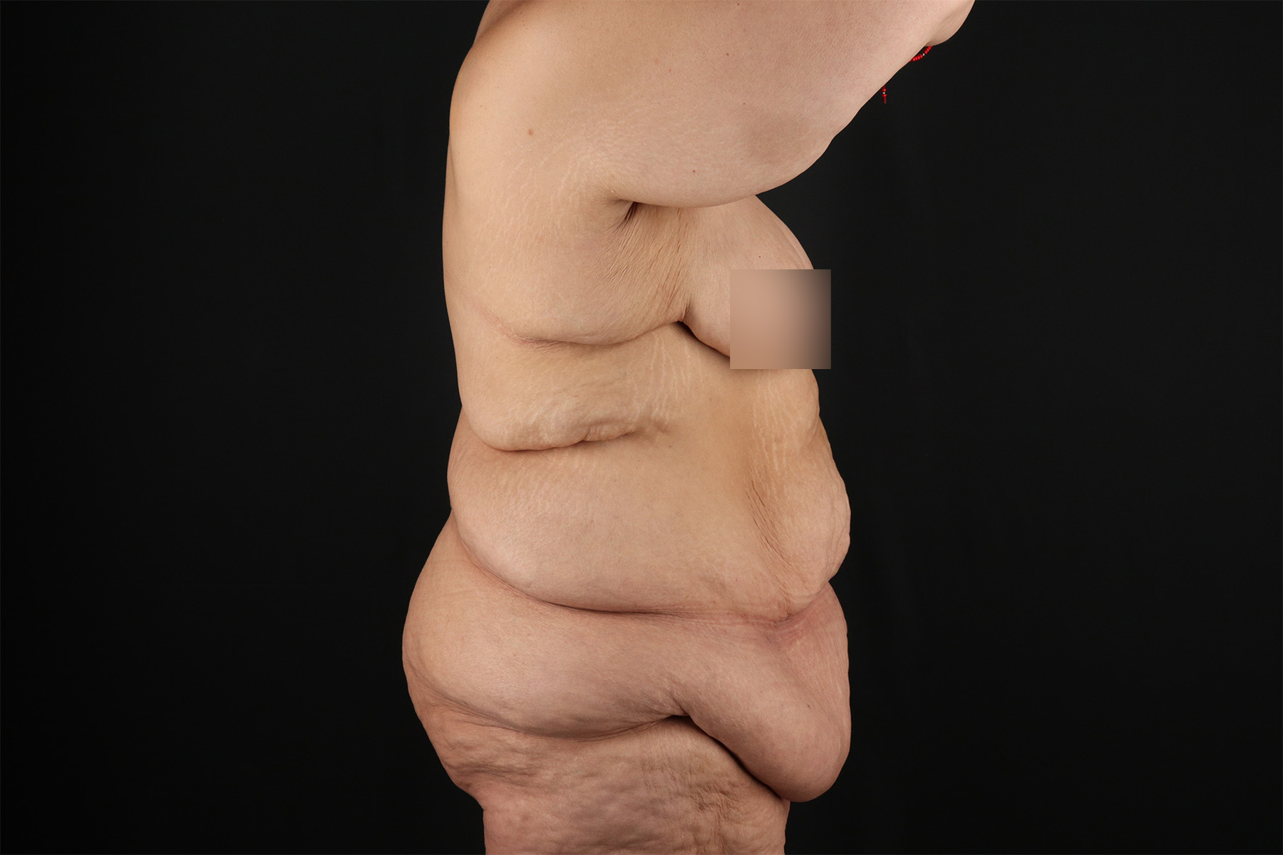 Fleur De Lis Tummy Tuck Before & After Patient #9509