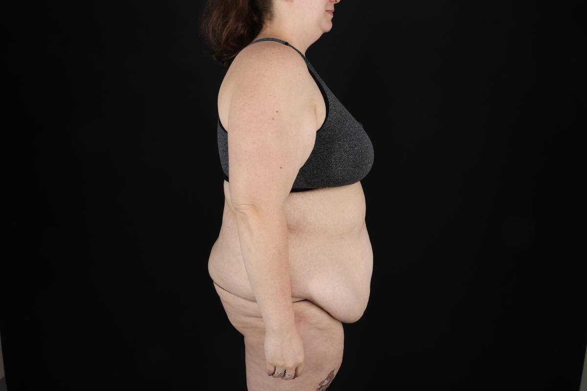 Fleur De Lis Circumferential Body Lift Before & After Patient #9284