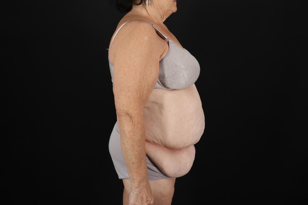 Fleur De Lis Tummy Tuck Before & After Patient #9507