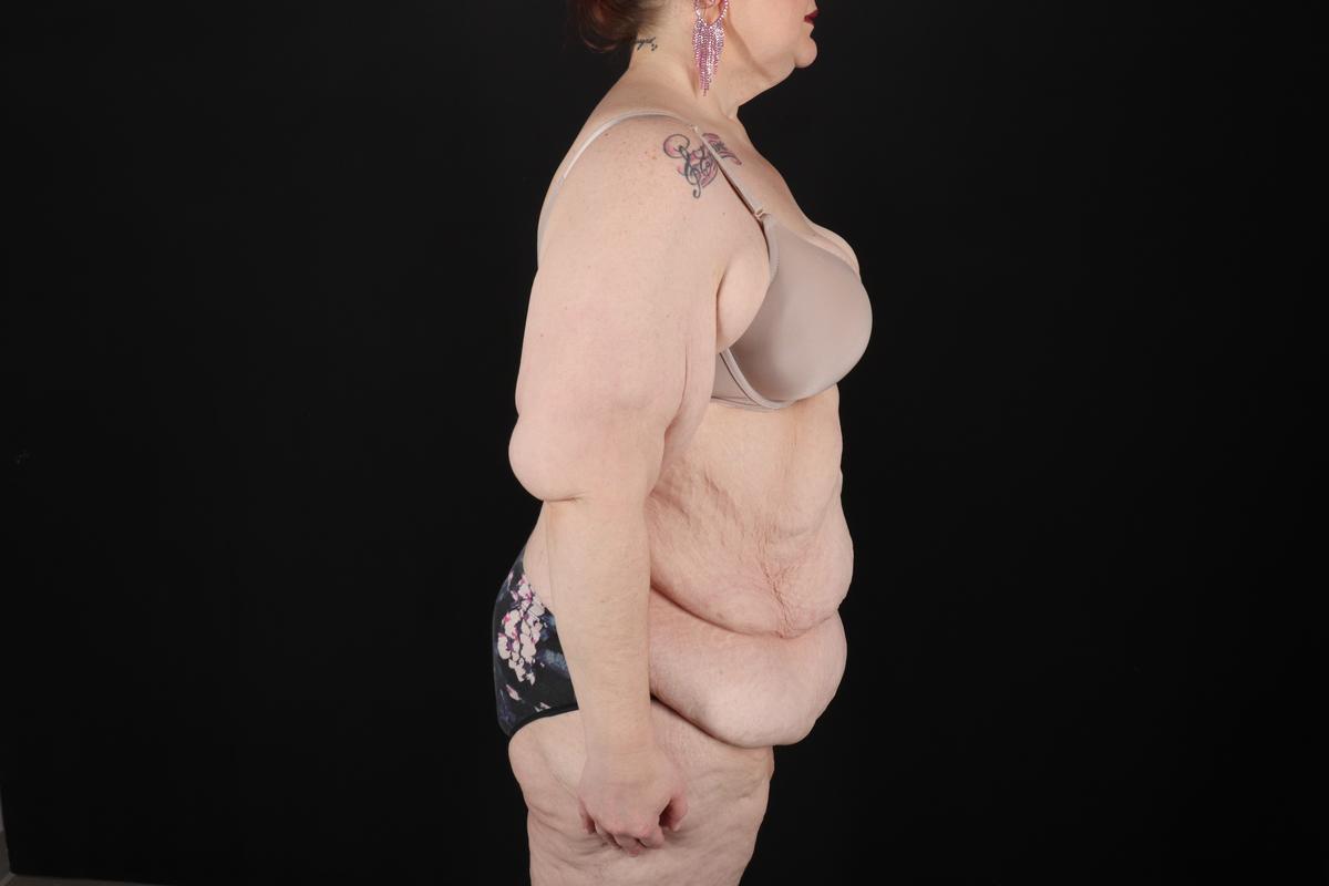 Fleur De Lis Circumferential Body Lift Before & After Patient #9283