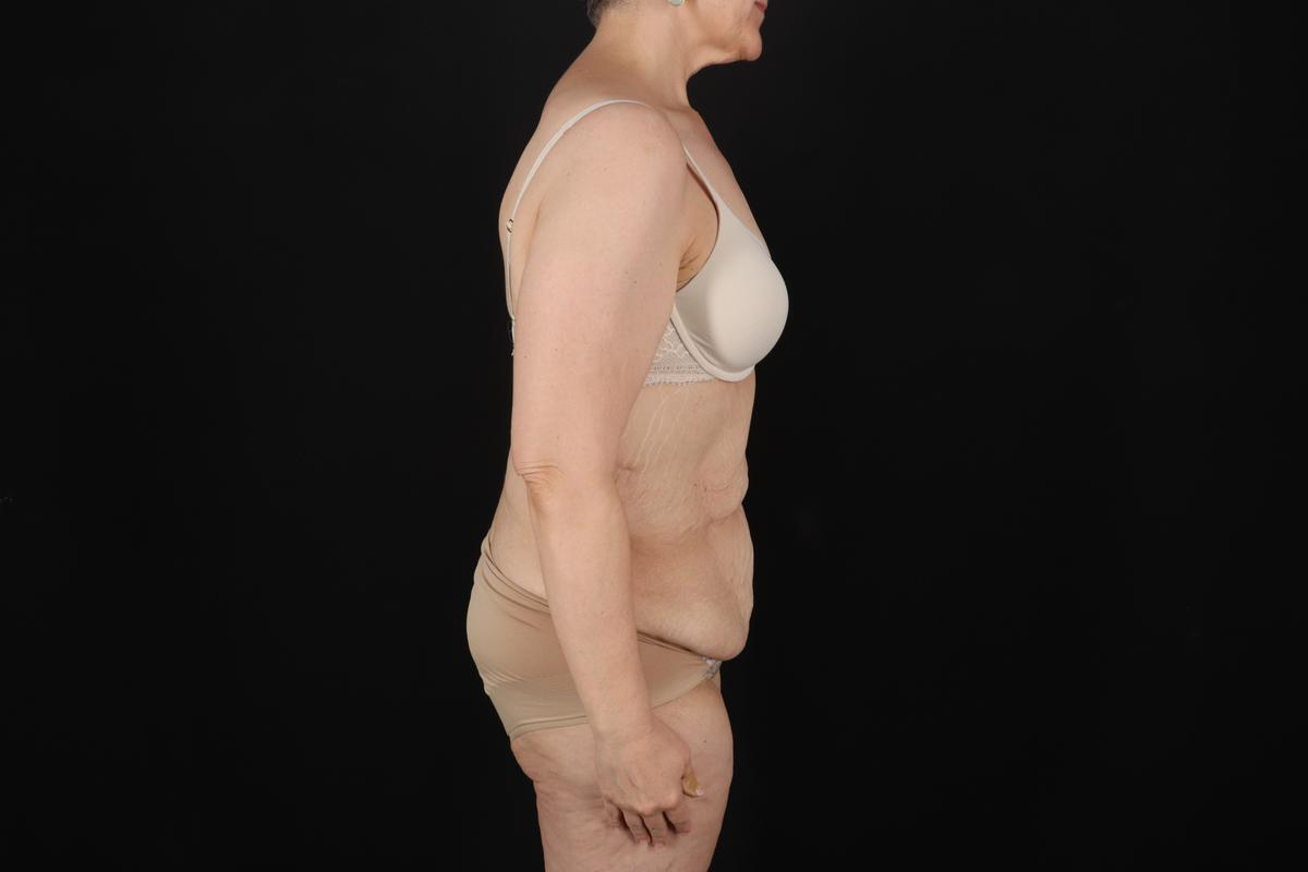 Fleur De Lis Circumferential Body Lift Before & After Patient #9328