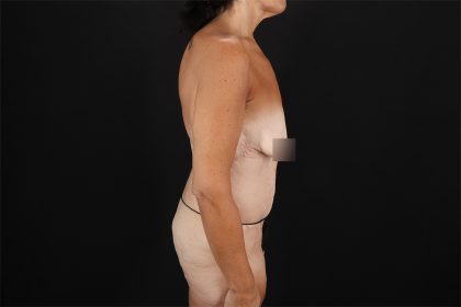 Fleur De Lis Circumferential Body Lift Before & After Patient #9279