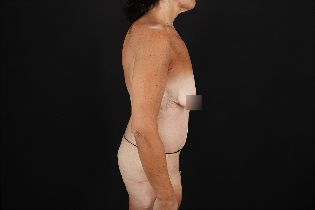 Fleur De Lis Circumferential Body Lift Before & After Patient #9279