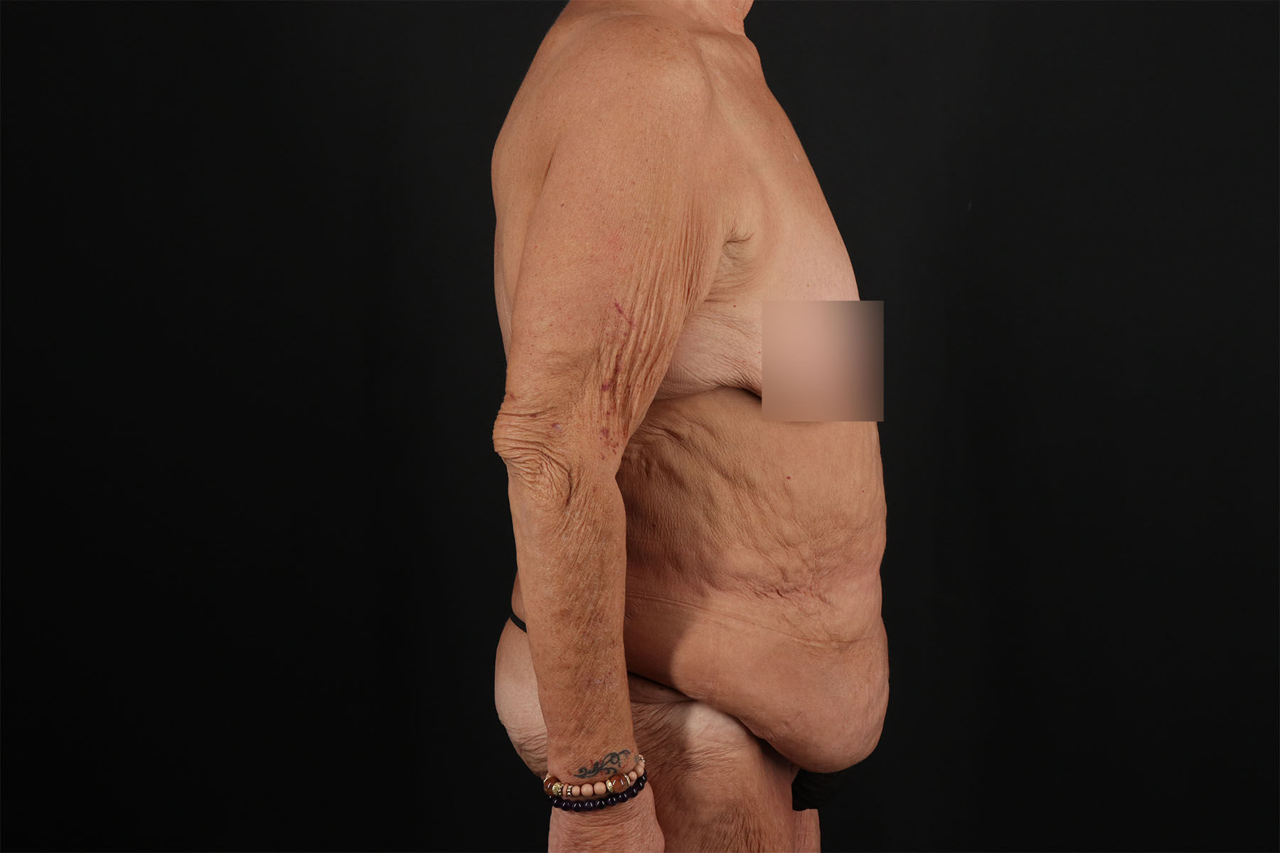 Fleur De Lis Circumferential Body Lift Before & After Patient #9281
