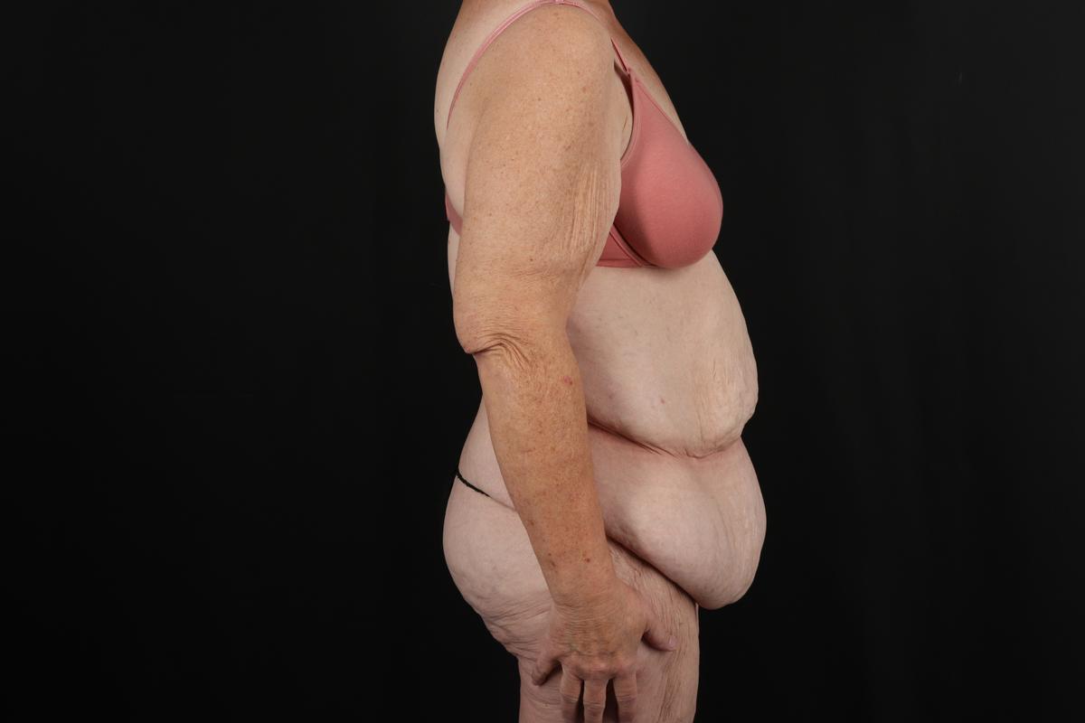 Fleur De Lis Circumferential Body Lift Before & After Patient #9285