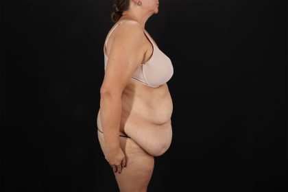 Fleur De Lis Tummy Tuck Before & After Patient #9510