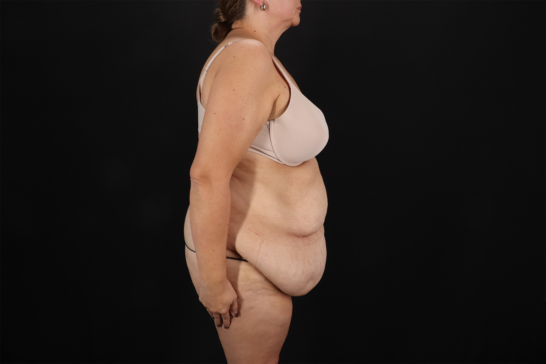 Fleur De Lis Tummy Tuck Before & After Patient #9510