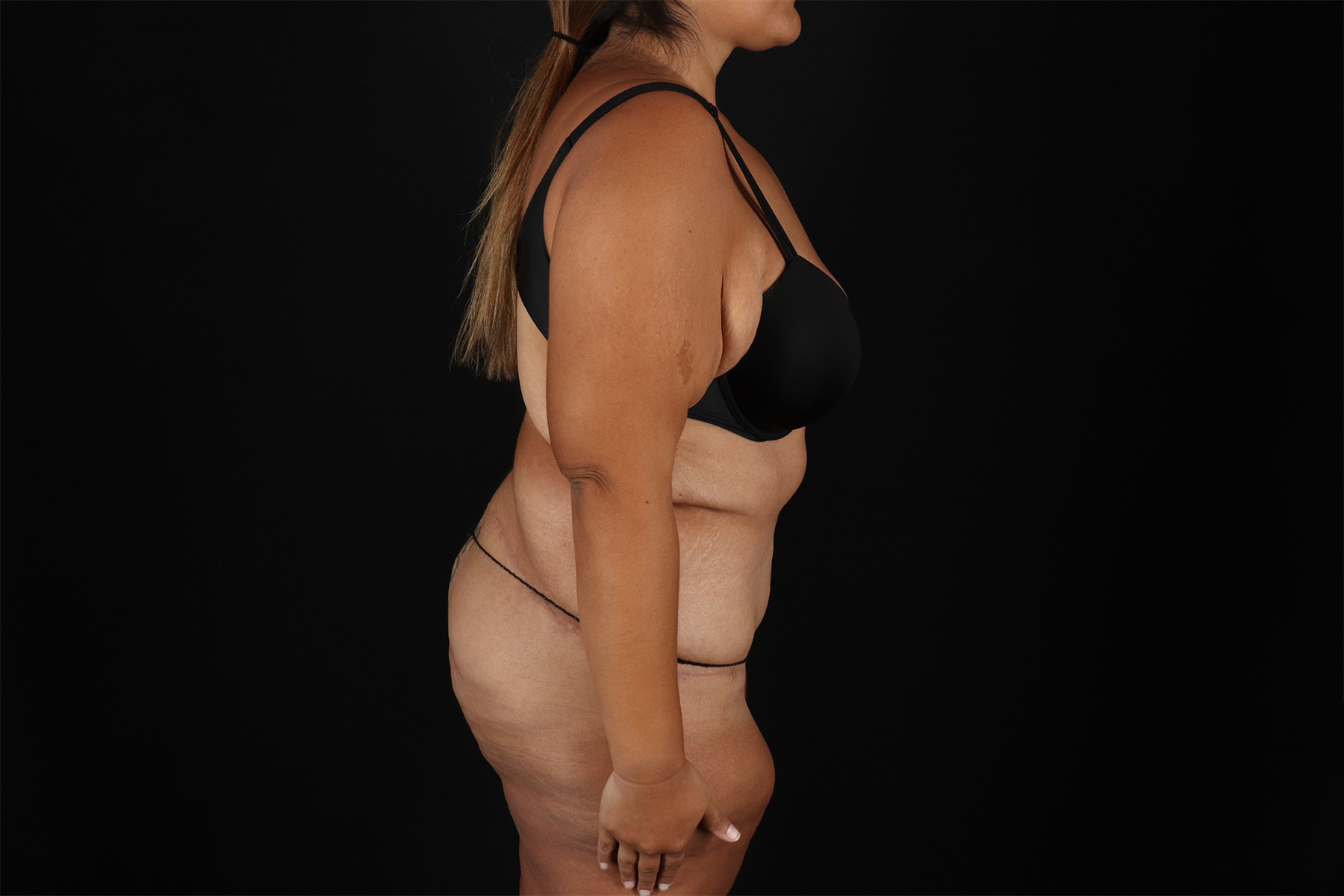 Fleur De Lis Tummy Tuck Before & After Patient #9508