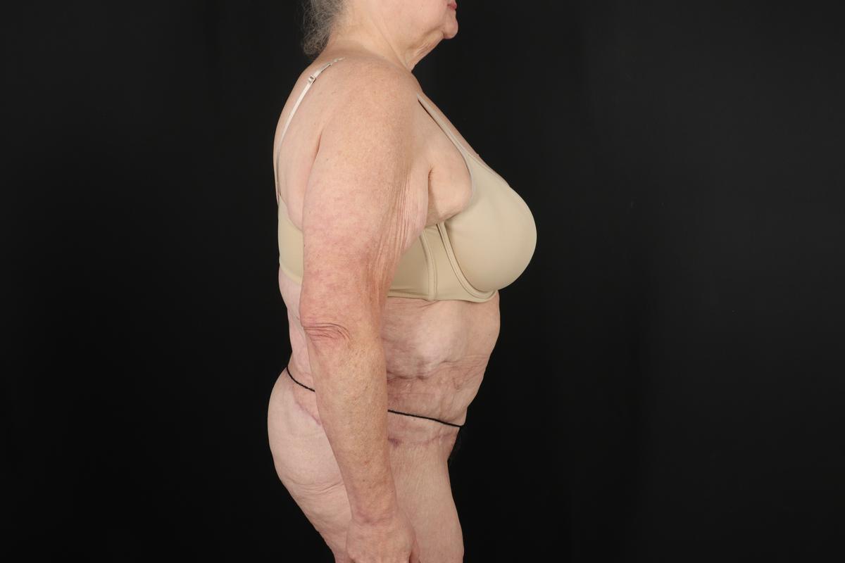 Fleur De Lis Circumferential Body Lift Before & After Patient #9286