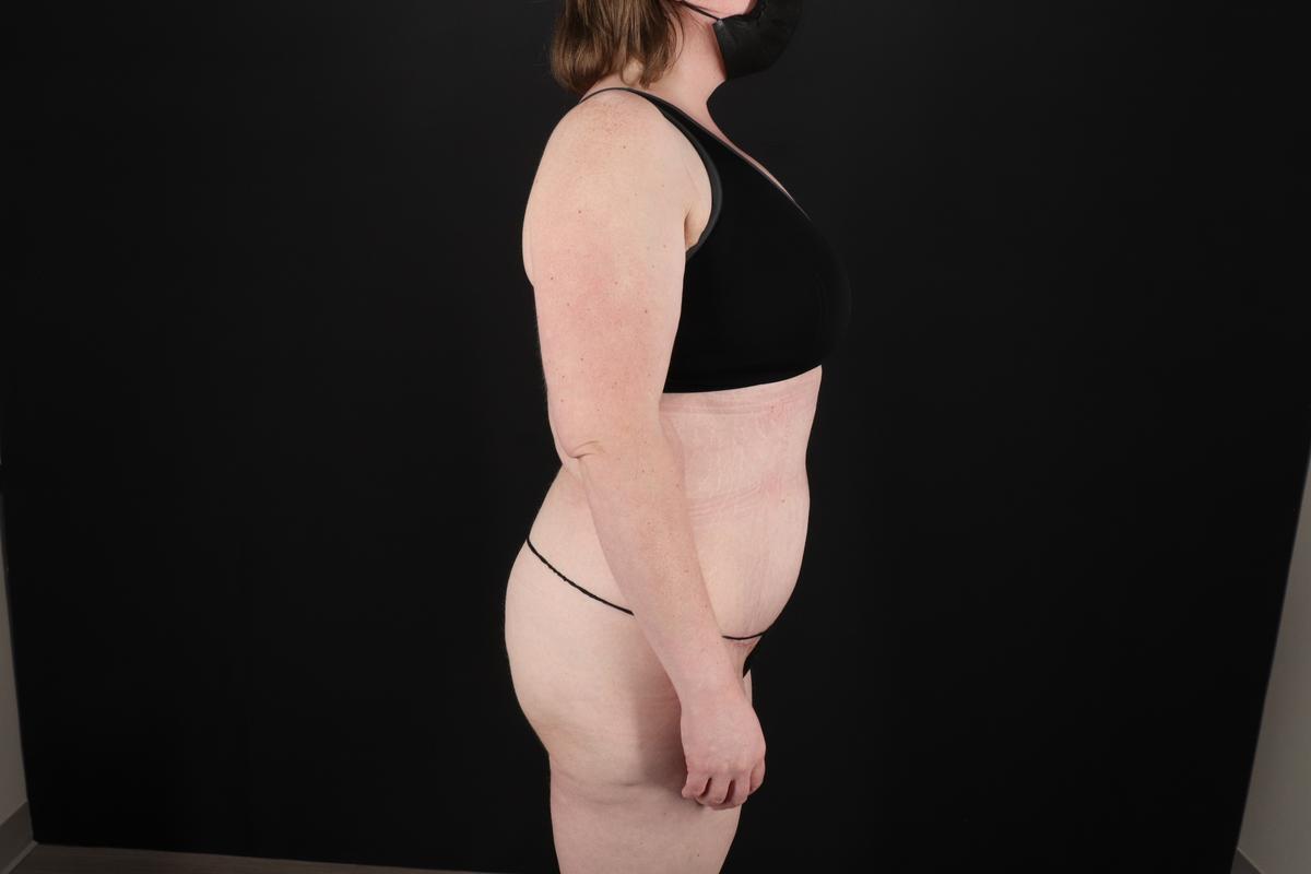 Fleur De Lis Tummy Tuck Before & After Patient #9506