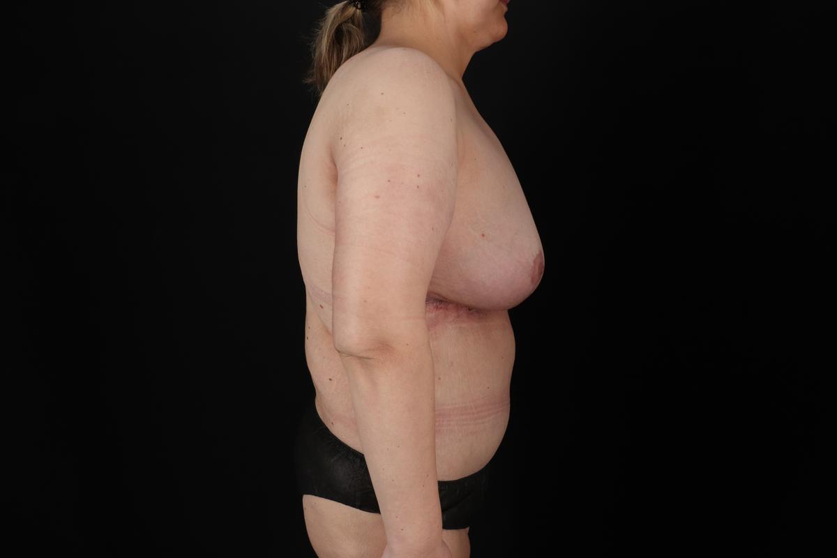 Fleur De Lis Circumferential Body Lift Before & After Patient #9287