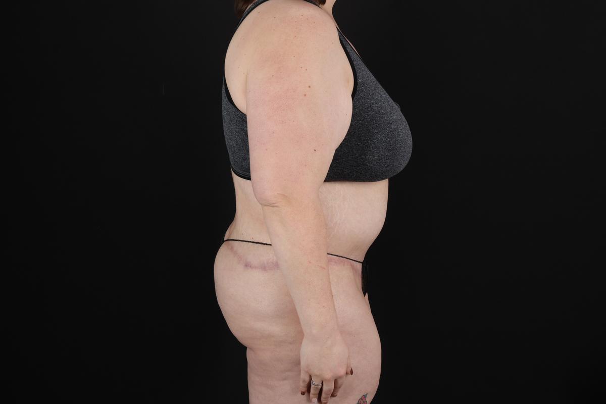 Fleur De Lis Circumferential Body Lift Before & After Patient #9284