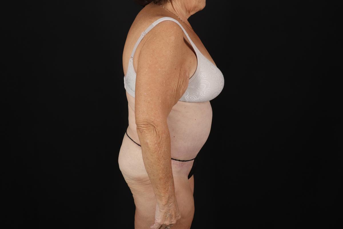 Fleur De Lis Tummy Tuck Before & After Patient #9507