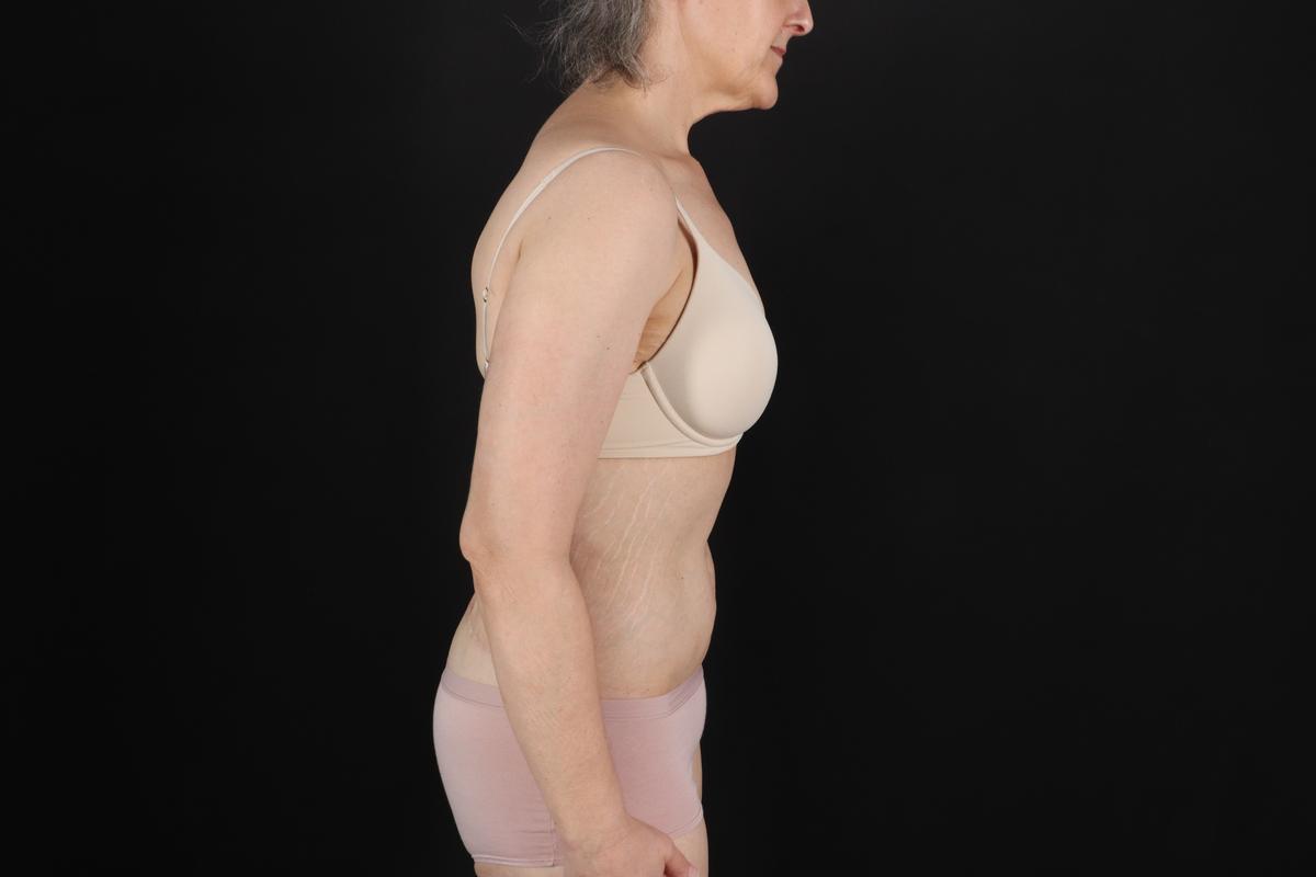 Fleur De Lis Circumferential Body Lift Before & After Patient #9328