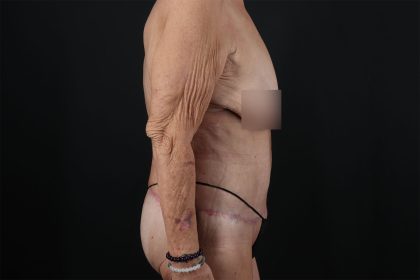 Fleur De Lis Circumferential Body Lift Before & After Patient #9281