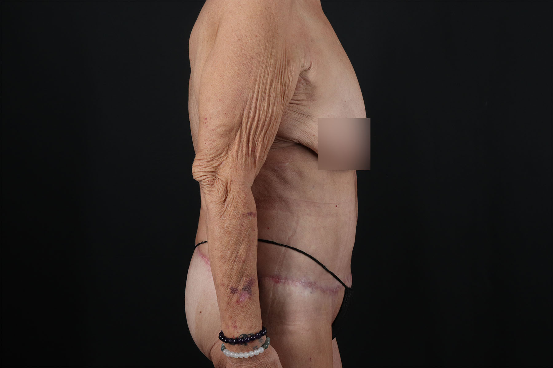 Fleur De Lis Circumferential Body Lift Before & After Patient #9281