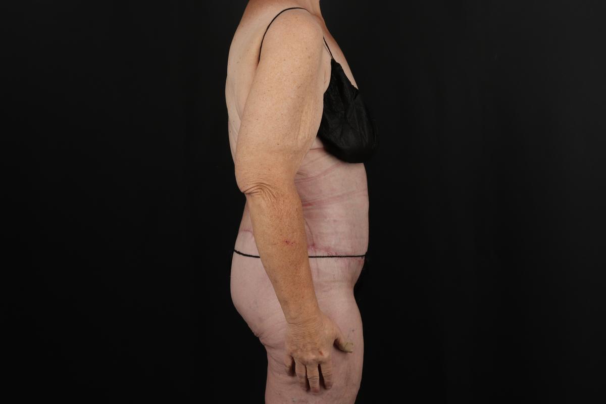 Fleur De Lis Circumferential Body Lift Before & After Patient #9285
