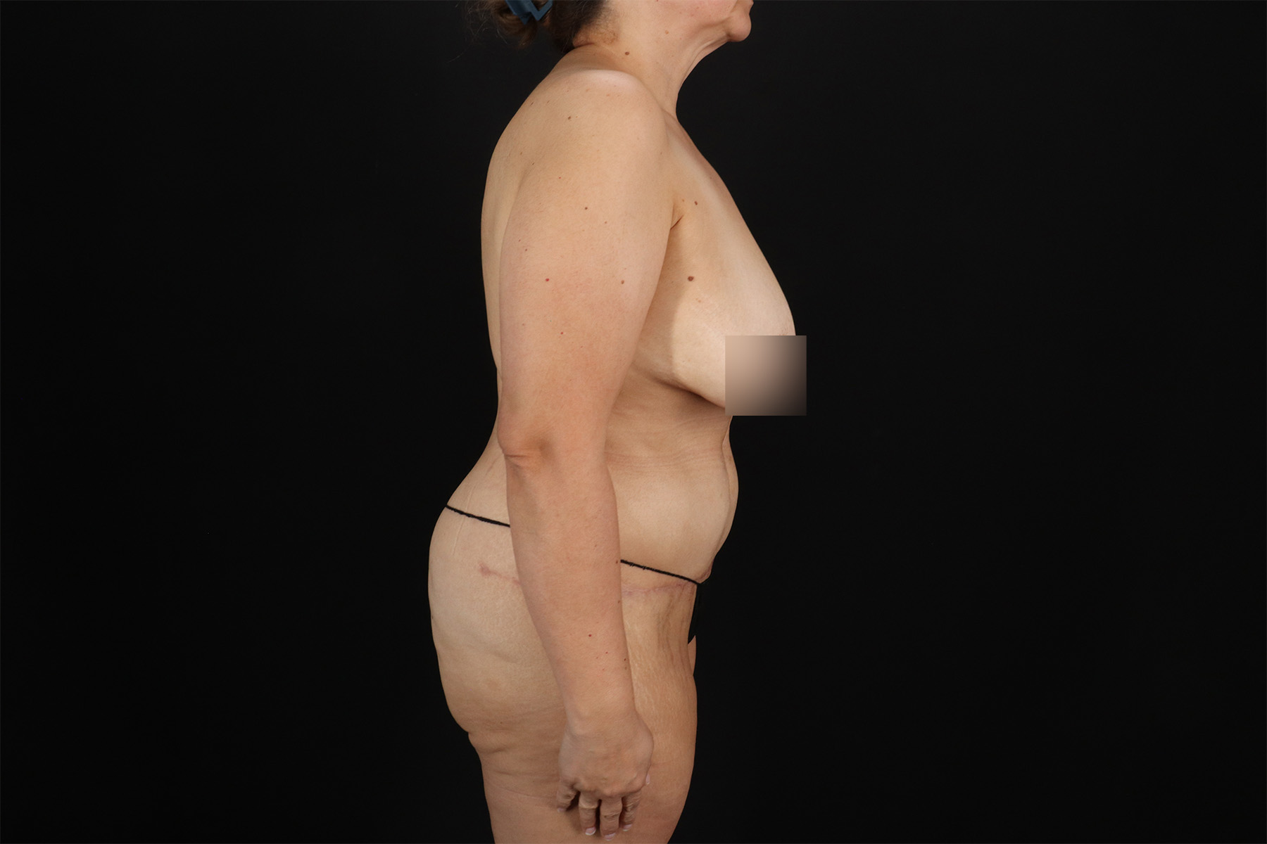 Fleur De Lis Tummy Tuck Before & After Patient #9510