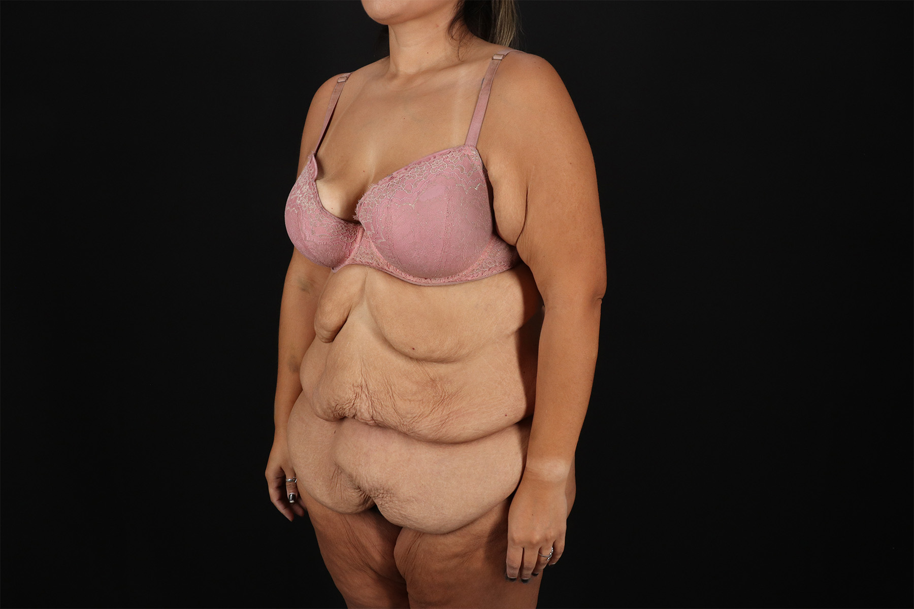 Fleur De Lis Tummy Tuck Before & After Patient #9508