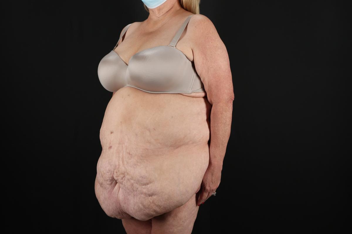 Fleur De Lis Circumferential Body Lift Before & After Patient #9286