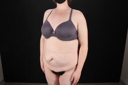 Fleur De Lis Tummy Tuck Before & After Patient #9506