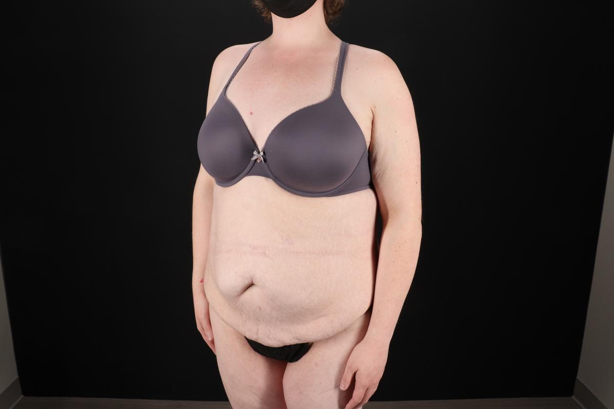 Fleur De Lis Tummy Tuck Before & After Patient #9506