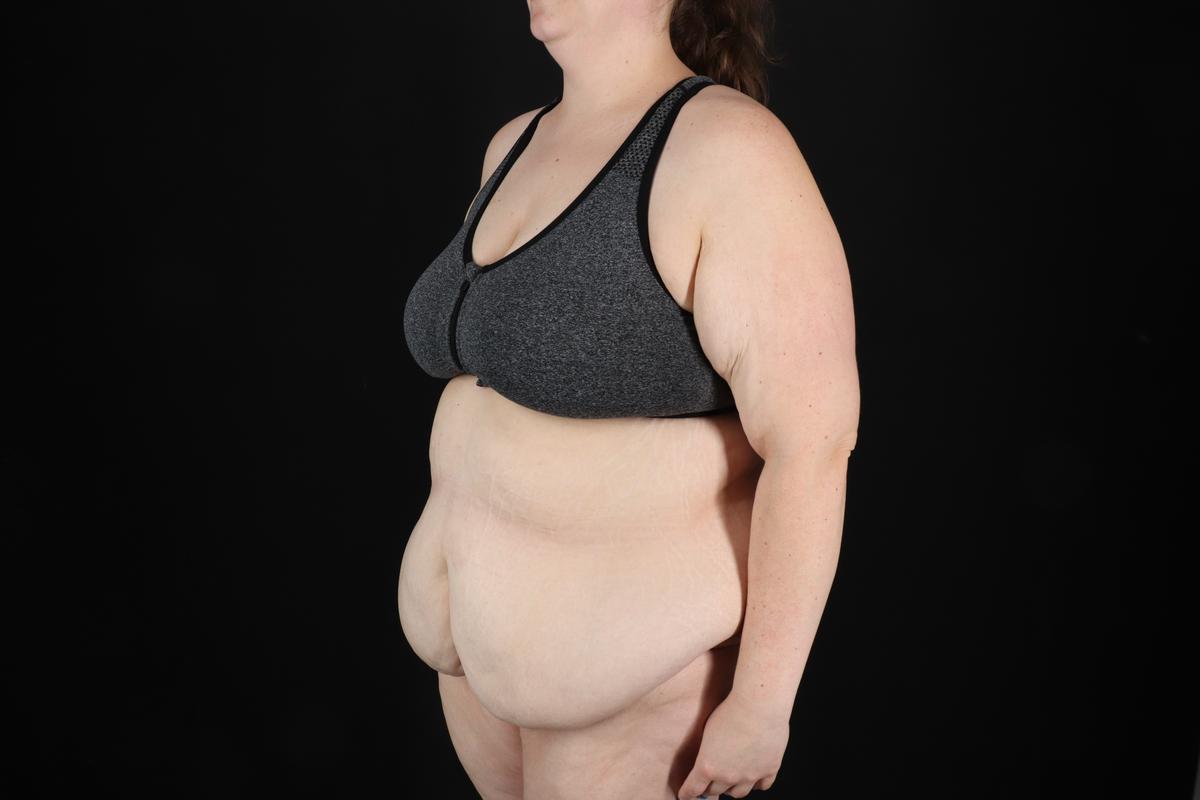 Fleur De Lis Circumferential Body Lift Before & After Patient #9284