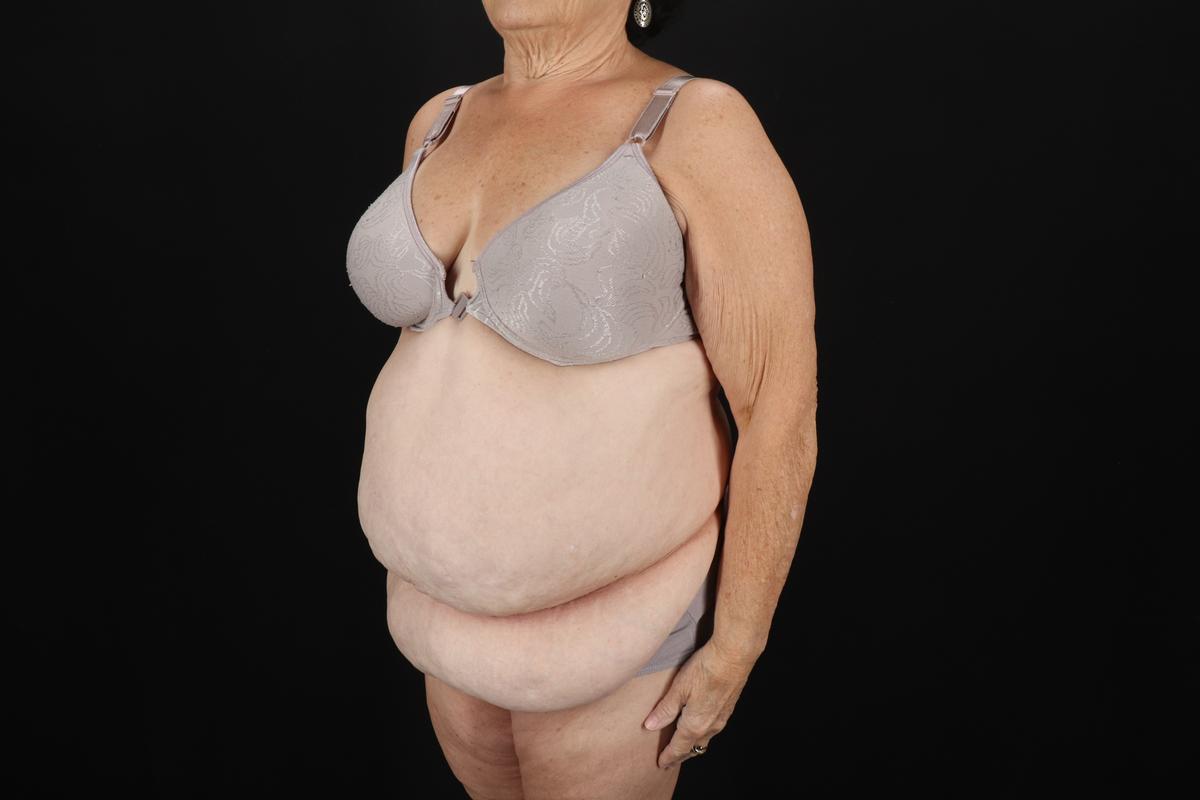 Fleur De Lis Tummy Tuck Before & After Patient #9507