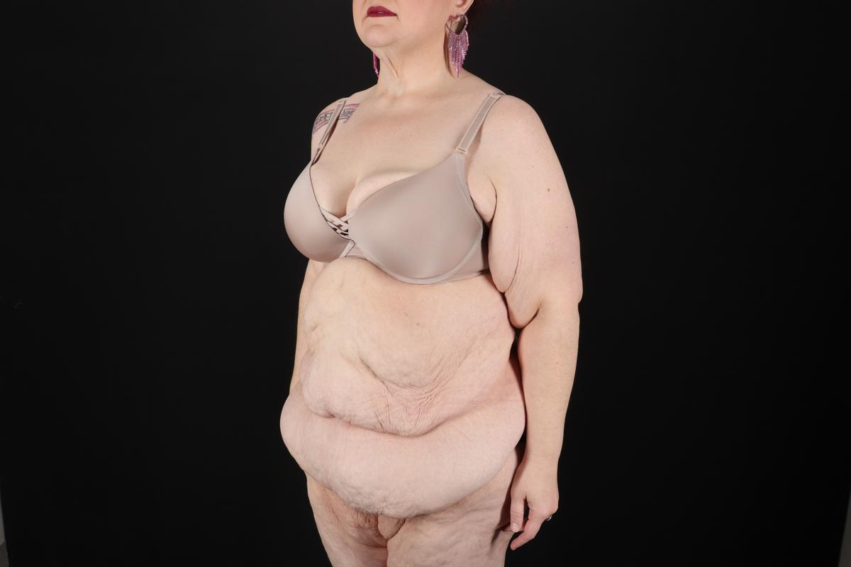 Fleur De Lis Circumferential Body Lift Before & After Patient #9283