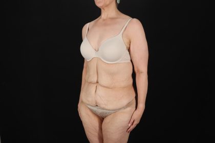 Fleur De Lis Circumferential Body Lift Before & After Patient #9328